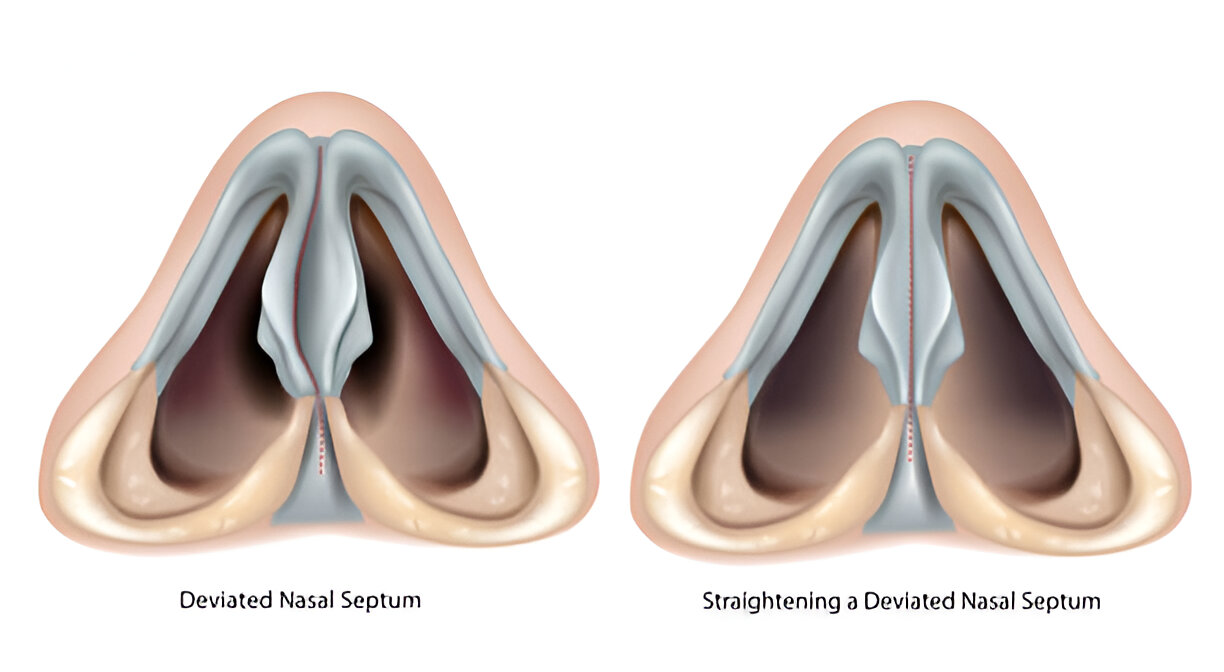 Deviated Septum Surgery in Dubai | Dr. Mustafa Kapadia