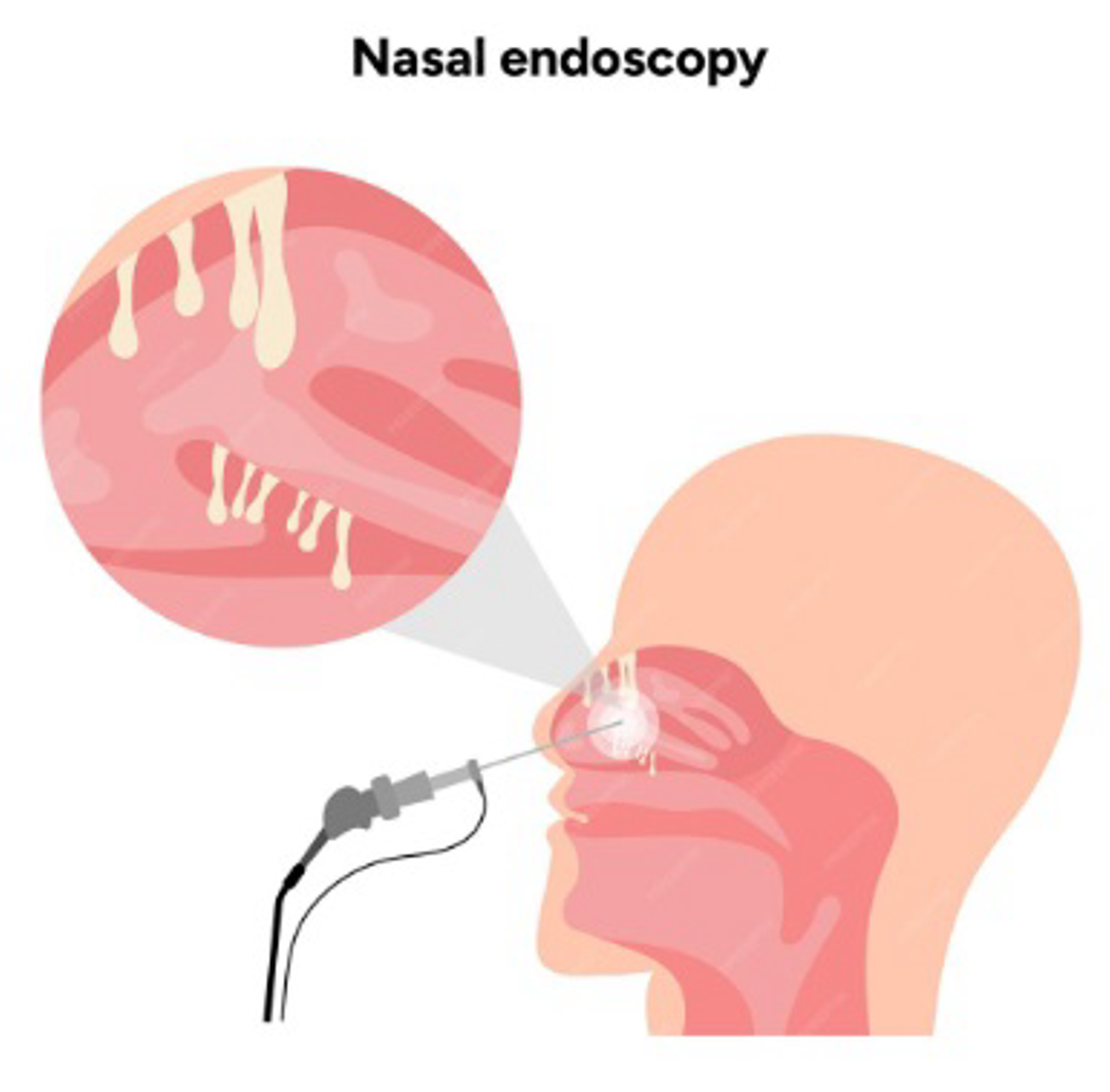 What Do Nasal Polyps Look Like