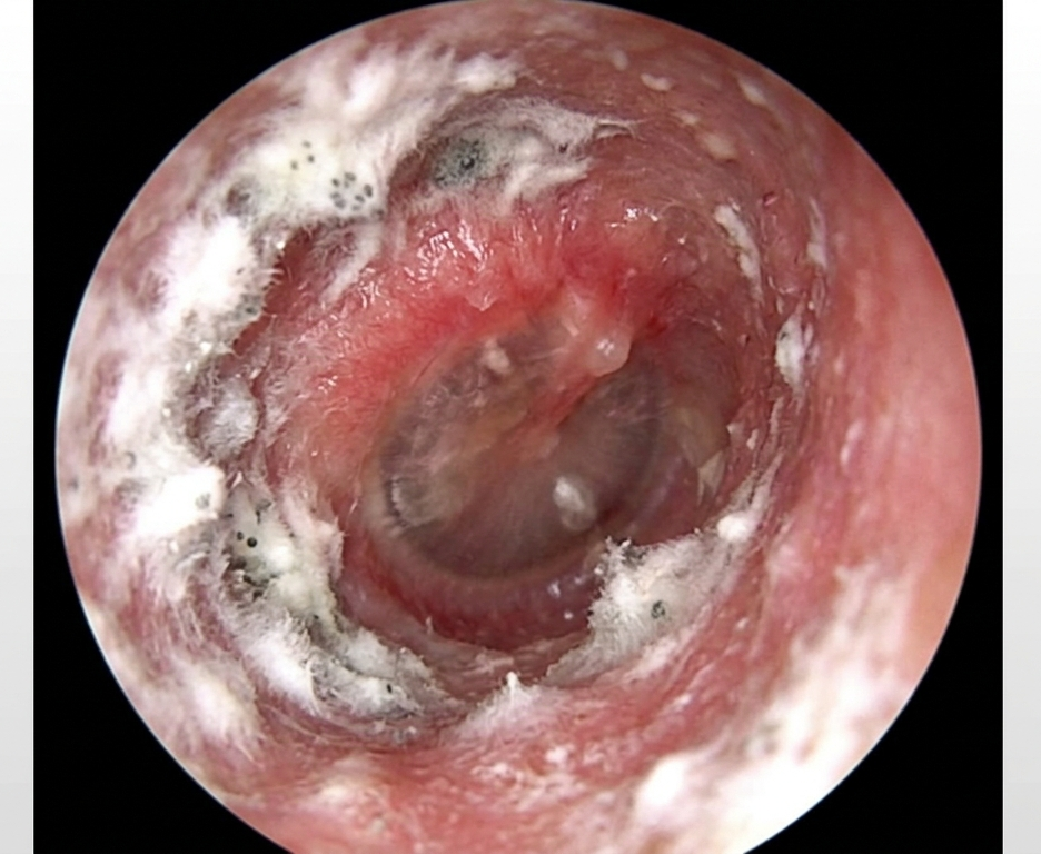 Fungal Ear Infection
