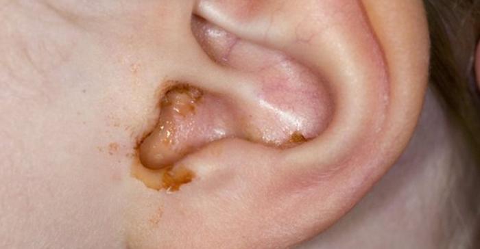 Ear Infection Treatment